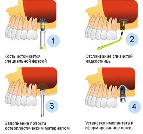Аугментация в стоматологии