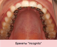Брекеты